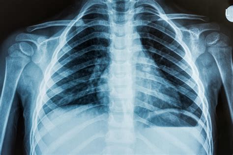 Understanding Apmlitude In Xrays: How Subtle Signals Reveal Disease