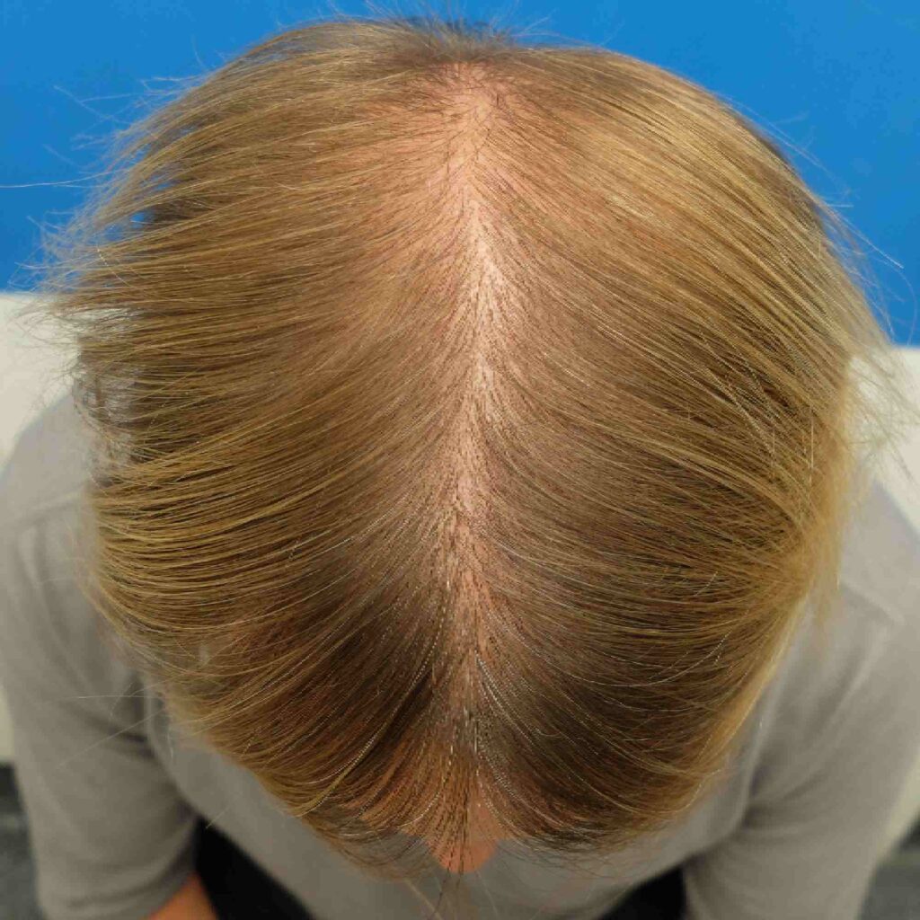 Don't Fall For These Mistakes With Female Hair Plugs