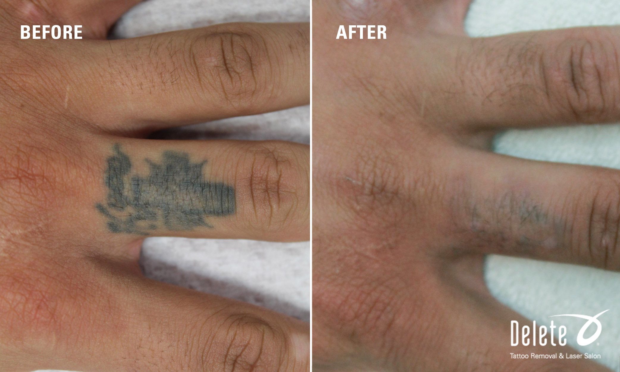 Laser Tattoo Before And After: Quick Fixes For Fast Results