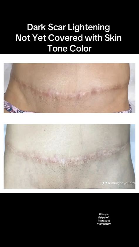 Mastering Tummy Tuck Tattoo Cover Up Achieving Flawless Results With Mastering Tummy Tuck Tattoo Cover Up Achieving Flawless Results With