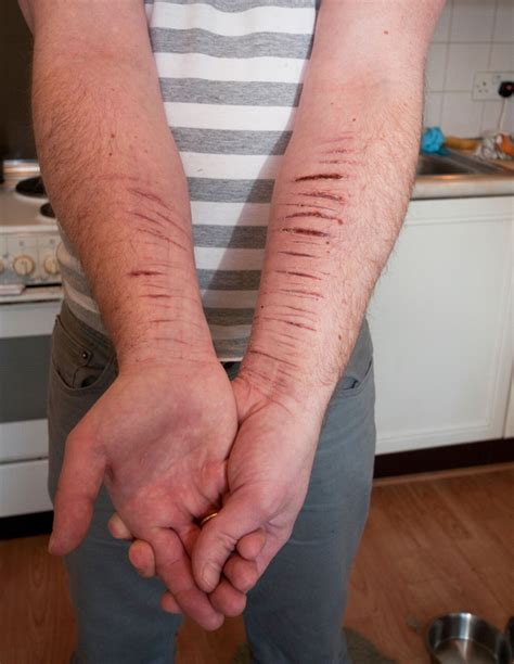 Self Harm On Wrist Self Harm On Wrist