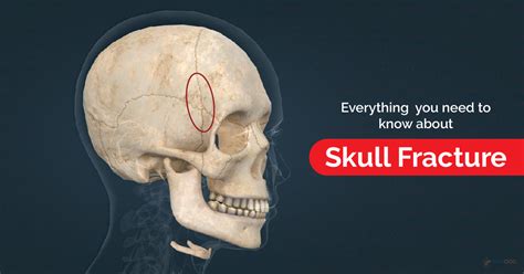 Master Skull Fracture Exercises For Safer Recovery