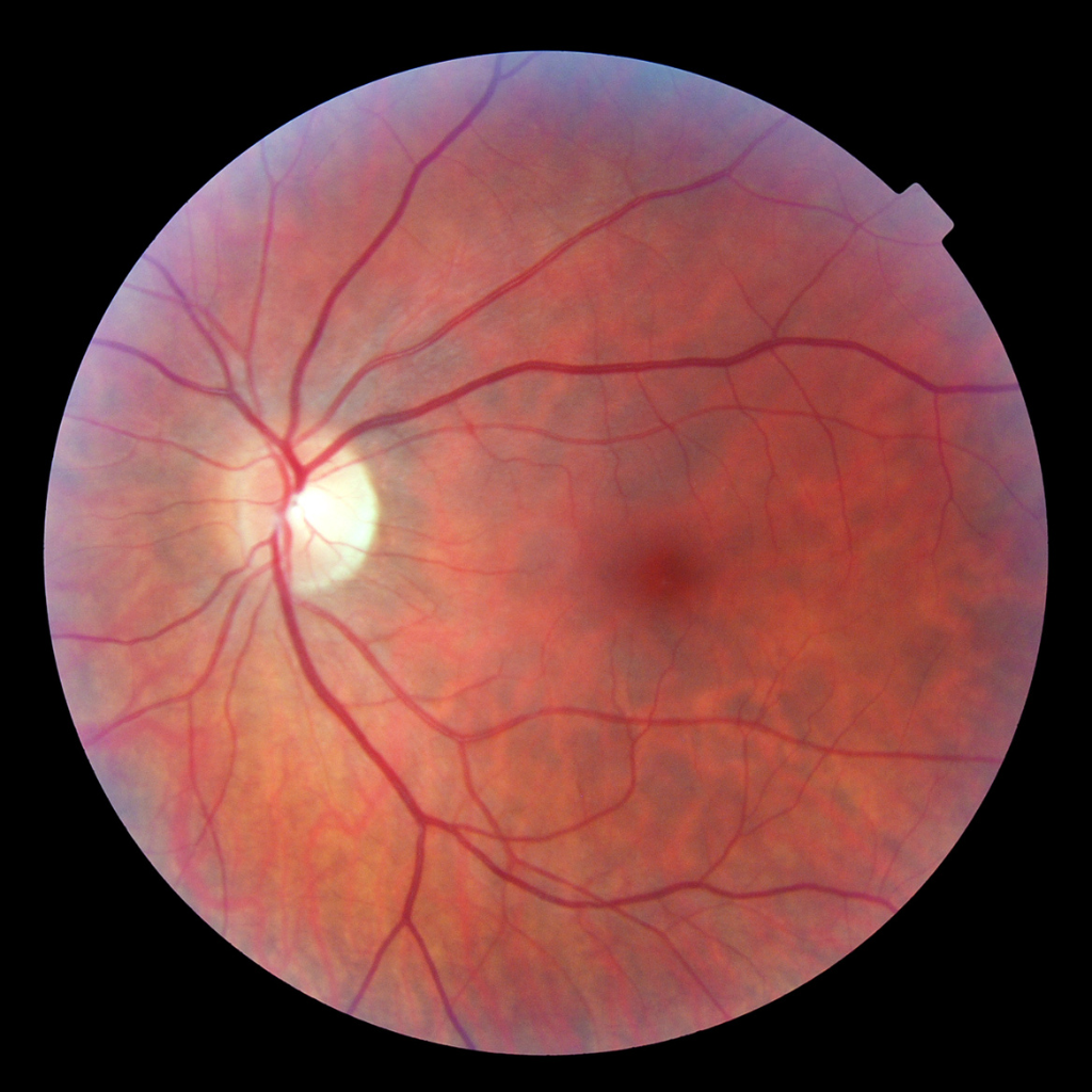 Visual Impairment Wikipedia