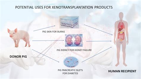 Xenotransplantation Transplanting Genetically Modified Pig Kidneys Into Patients